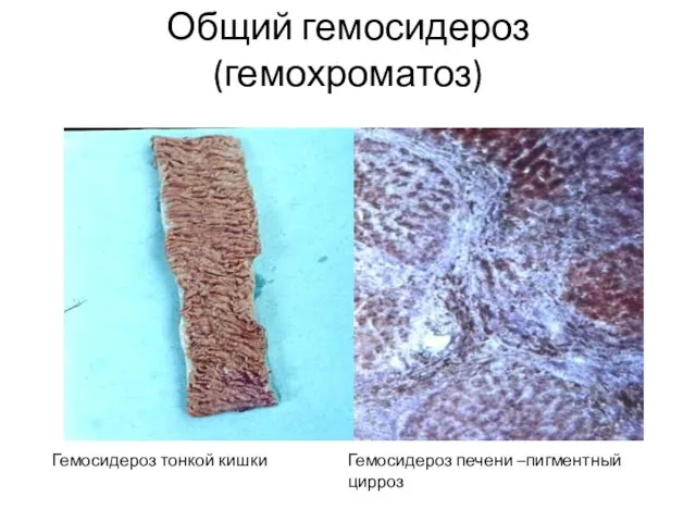 Общий гемосидероз (гемохроматоз) Гемосидероз тонкой кишки Гемосидероз печени –пигментный цирроз
