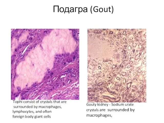 Подагра (Gout) Тophi consist of crystals that are surrounded by