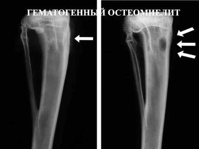 ГЕМАТОГЕННЫЙ ОСТЕОМИЕЛИТ