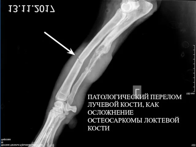 ПАТОЛОГИЧЕСКИЙ ПЕРЕЛОМ ЛУЧЕВОЙ КОСТИ, КАК ОСЛОЖНЕНИЕ ОСТЕОСАРКОМЫ ЛОКТЕВОЙ КОСТИ