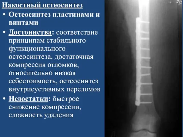 Накостный остеосинтез Остеосинтез пластинами и винтами Достоинства: соответствие принципам стабильного