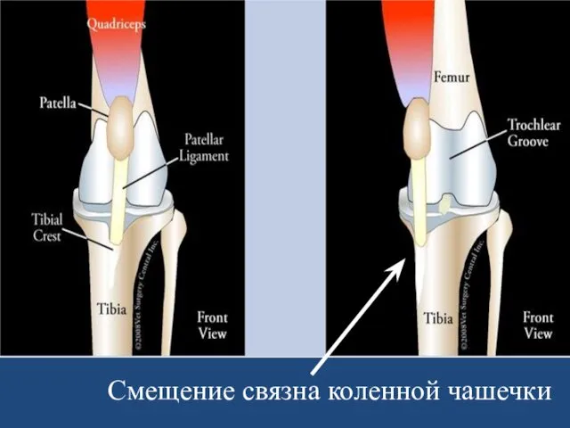 Смещение связна коленной чашечки