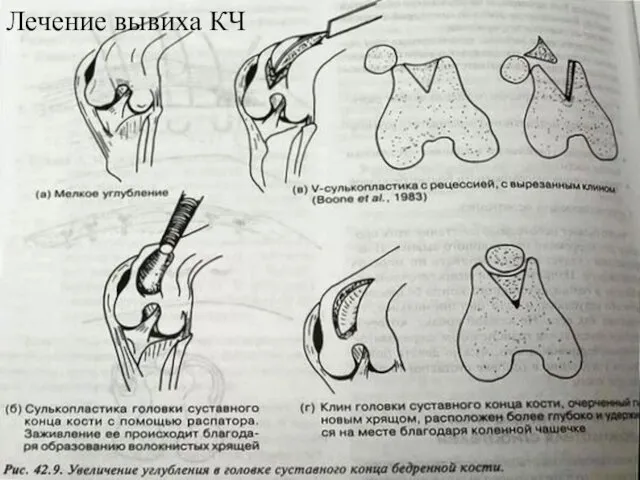 Лечение вывиха КЧ