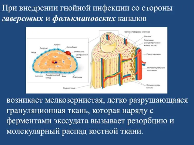 При внедрении гнойной инфекции со стороны гаверсовых и фолькмановских каналов