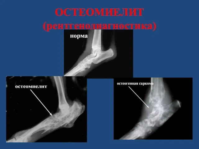 ОСТЕОМИЕЛИТ (рентгенодиагностика)