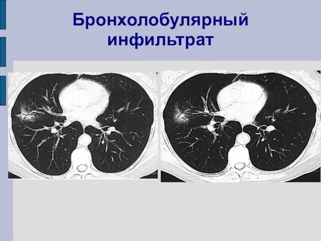 Бронхолобулярный инфильтрат