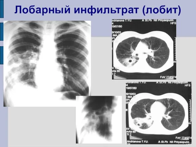 Лобарный инфильтрат (лобит)‏