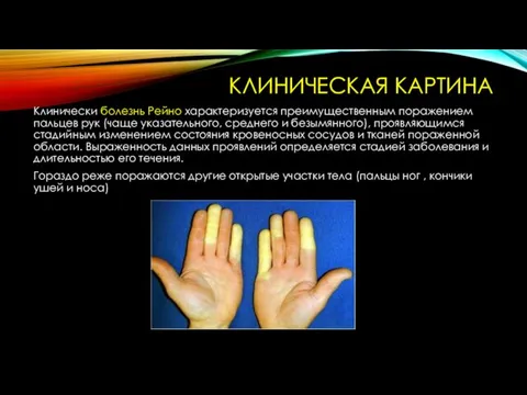 КЛИНИЧЕСКАЯ КАРТИНА Клинически болезнь Рейно характеризуется преимущественным поражением пальцев рук