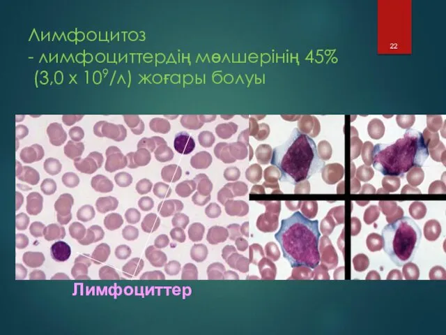 Лимфоцитоз - лимфоциттердің мөлшерінің 45% (3,0 х 109/л) жоғары болуы Лимфоциттер