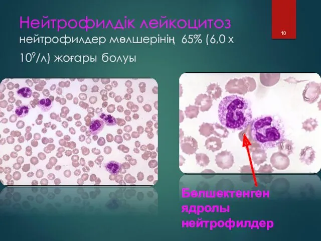 Нейтрофилдік лейкоцитоз нейтрофилдер мөлшерінің 65% (6,0 х 109/л) жоғары болуы Бөлшектенген ядролы нейтрофилдер