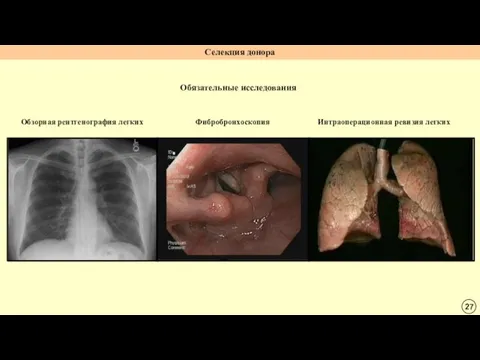 Обязательные исследования Селекция донора Обзорная рентгенография легких Фибробронхоскопия Интраоперационная ревизия легких
