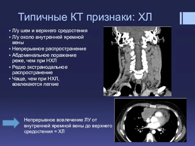 Типичные КТ признаки: ХЛ Л/у шеи и верхнего средостения Л/у