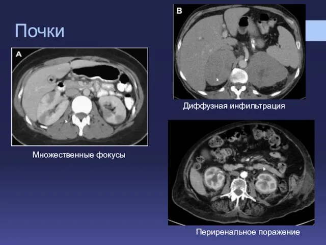Почки Диффузная инфильтрация Множественные фокусы Периренальное поражение