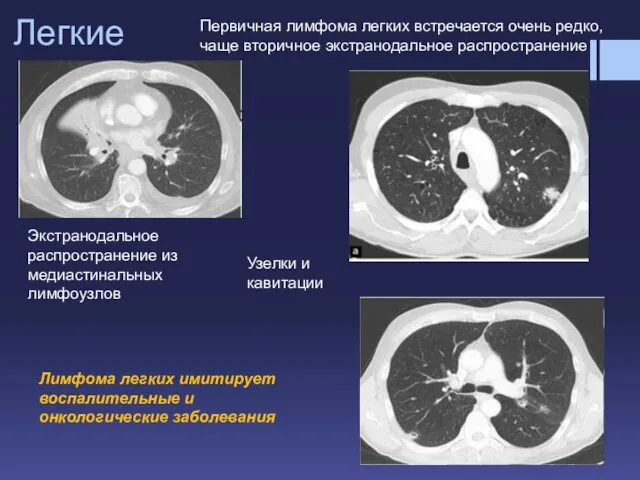 Легкие Первичная лимфома легких встречается очень редко, чаще вторичное экстранодальное