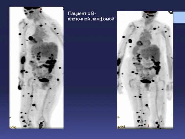 Пациент с В-клеточной лимфомой