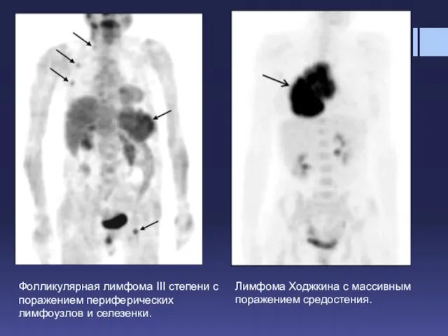 Фолликулярная лимфома III степени с поражением периферических лимфоузлов и селезенки. Лимфома Ходжкина с массивным поражением средостения.