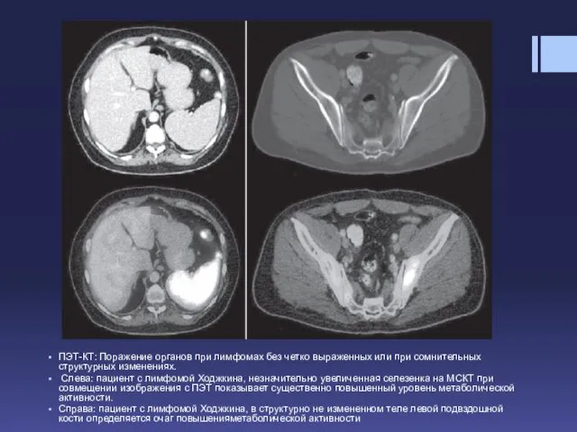 ПЭТ-КТ: Поражение органов при лимфомах без четко выраженных или при