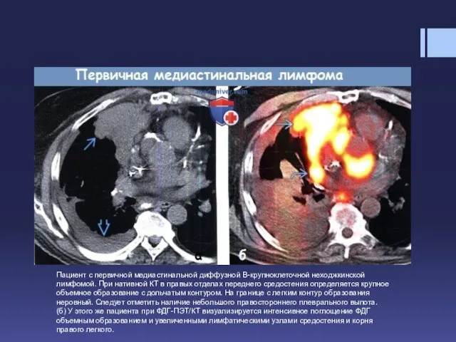 Пациент с первичной медиастинальной диффузной В-крупноклеточной неходжкинской лимфомой. При нативной