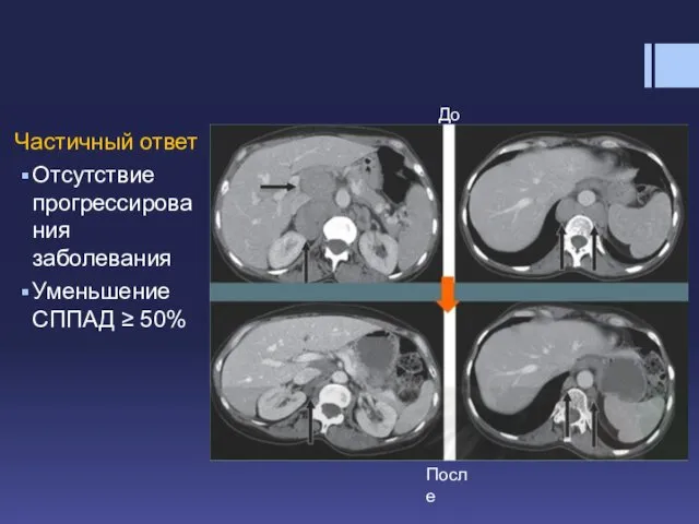 Частичный ответ Отсутствие прогрессирования заболевания Уменьшение СППАД ≥ 50% До После