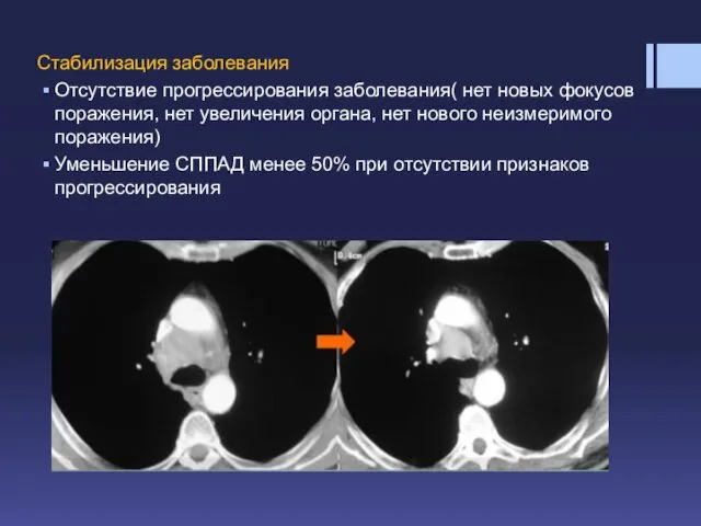 Стабилизация заболевания Отсутствие прогрессирования заболевания( нет новых фокусов поражения, нет