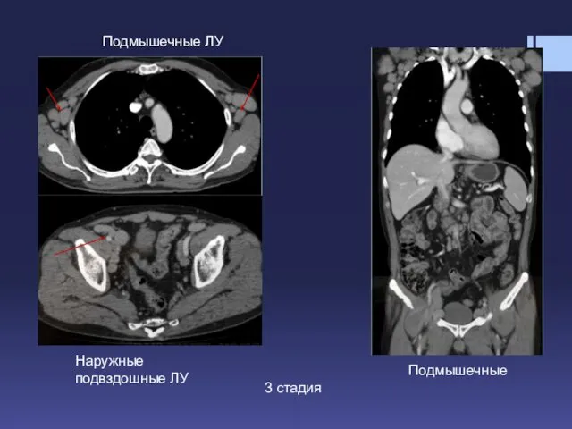 Подмышечные ЛУ Наружные подвздошные ЛУ Подмышечные 3 стадия