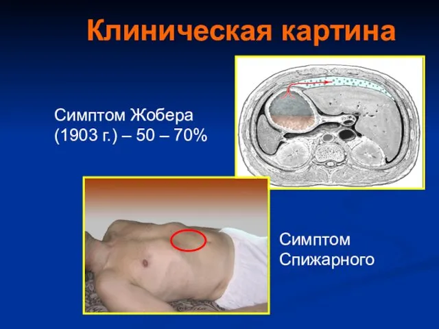 Клиническая картина Симптом Жобера (1903 г.) – 50 – 70% Симптом Спижарного