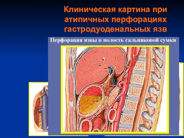 Клиническая картина при атипичных перфорациях гастродуоденальных язв