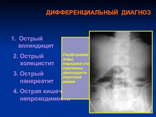 ДИФФЕРЕНЦИАЛЬНЫЙ ДИАГНОЗ Острый аппендицит 2. Острый холецистит 3. Острый панкреатит 4. Острая кишечная непроходимость