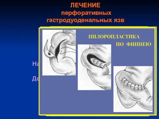 ЛЕЧЕНИЕ перфоративных гастродуоденальных язв Хирургическое лечение Наркоз – эндотрахеальный с ИВЛ. Доступ – верхняя срединная лапаротомия.