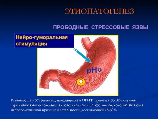 ЭТИОПАТОГЕНЕЗ ПРОБОДНЫЕ СТРЕССОВЫЕ ЯЗВЫ Нейро-гуморальная стимуляция рН⇩ Развиваются у 5%