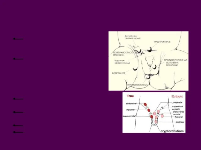 Аномалии развития яичка Гипоплазия или аплазия (естественная кастрация) Эктопия –