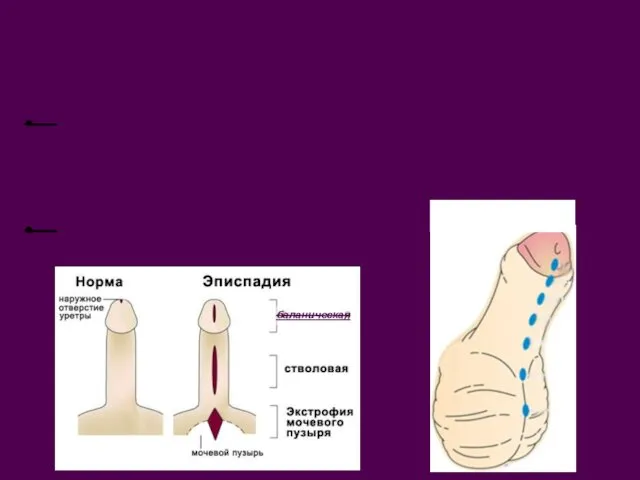 Аномалии развития МПО Гипоспадия расщепление мочеиспускательного канала по внутренней поверхности