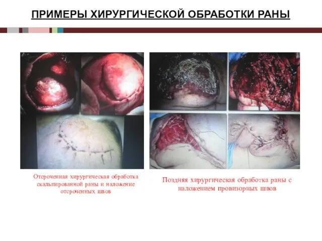 ПРИМЕРЫ ХИРУРГИЧЕСКОЙ ОБРАБОТКИ РАНЫ Отсроченная хирургическая обработка скальпированной раны и