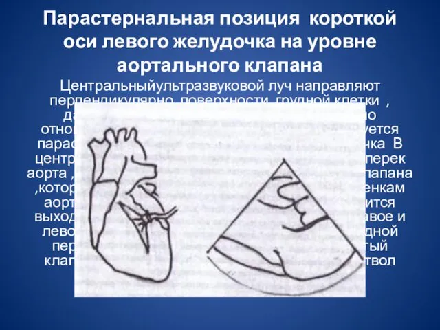 Парастернальная позиция короткой оси левого желудочка на уровне аортального клапана