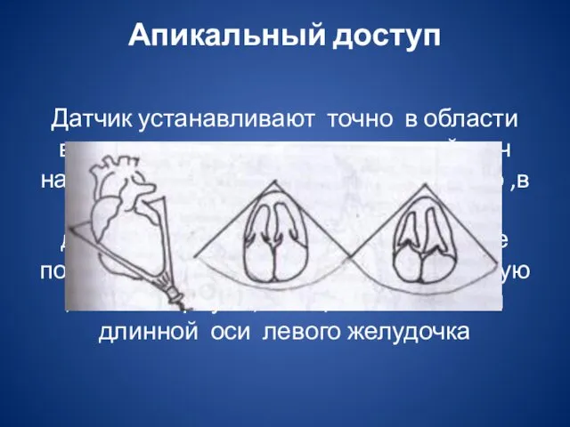 Апикальный доступ Датчик устанавливают точно в области верхушки сердца, ультразвуковой