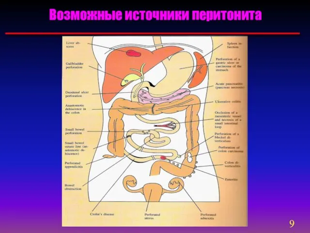 Возможные источники перитонита