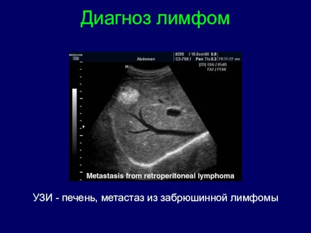 Диагноз лимфом УЗИ - печень, метастаз из забрюшинной лимфомы