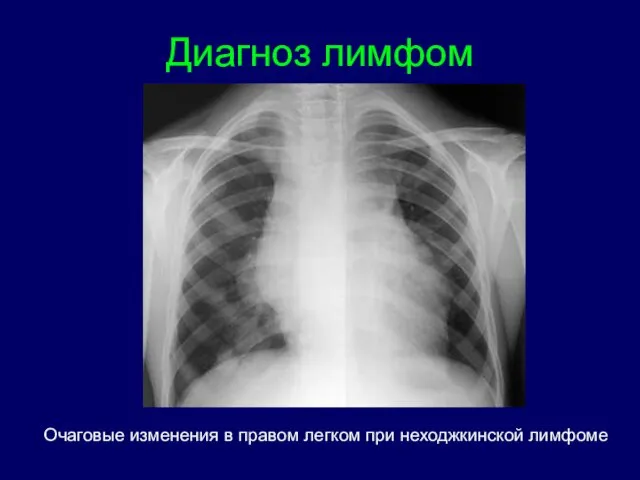 Очаговые изменения в правом легком при неходжкинской лимфоме Диагноз лимфом