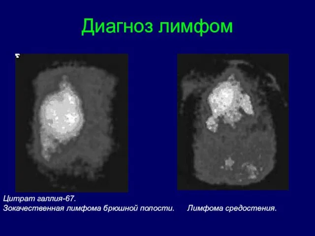 Цитрат галлия-67. Зокачественная лимфома брюшной полости. Лимфома средостения. Диагноз лимфом