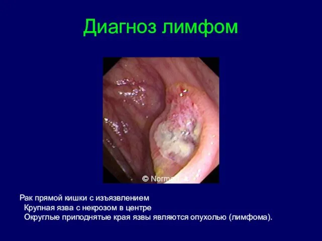 Диагноз лимфом Рак прямой кишки с изъязвлением Крупная язва с