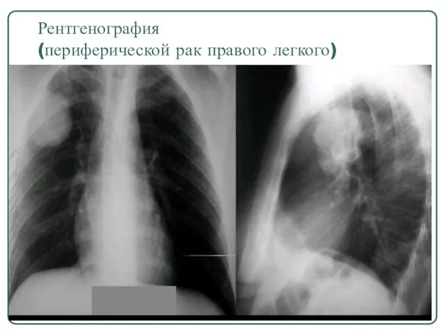 Рентгенография (периферической рак правого легкого)