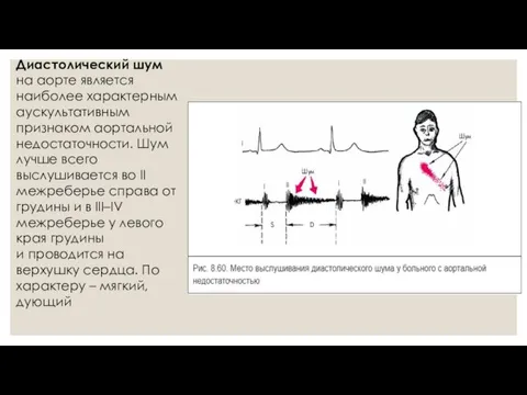 Диастолический шум на аорте является наиболее характерным аускультативным признаком аортальной