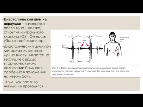 Диастолический шум на верхушке—начинается после тона (щелчка) открытия митрального клапана