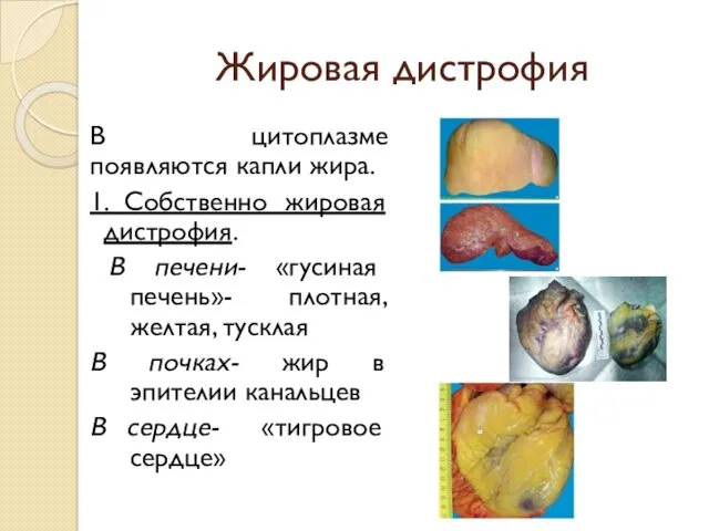 Жировая дистрофия В цитоплазме появляются капли жира. 1. Собственно жировая