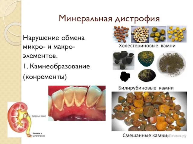 Минеральная дистрофия Нарушение обмена микро- и макро-элементов. 1. Камнеобразование (конременты)