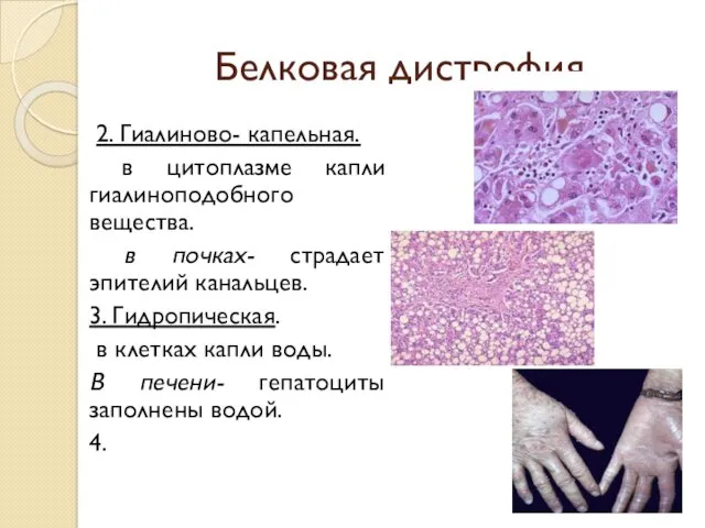 Белковая дистрофия 2. Гиалиново- капельная. в цитоплазме капли гиалиноподобного вещества.