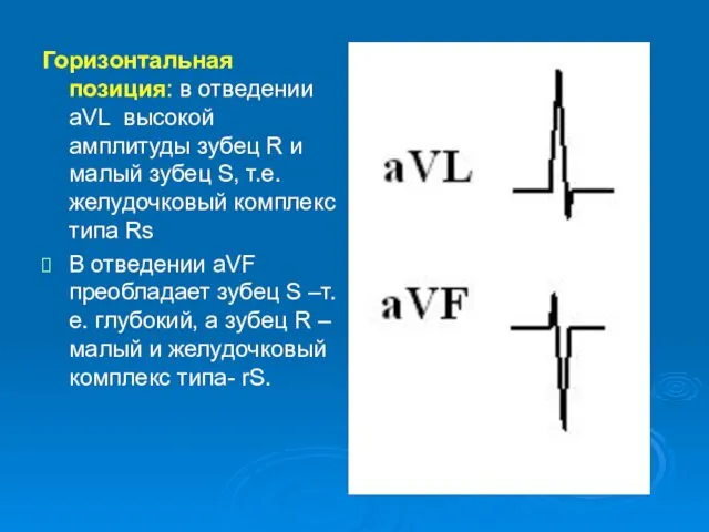 Горизонтальная позиция: в отведении аVL высокой амплитуды зубец R и