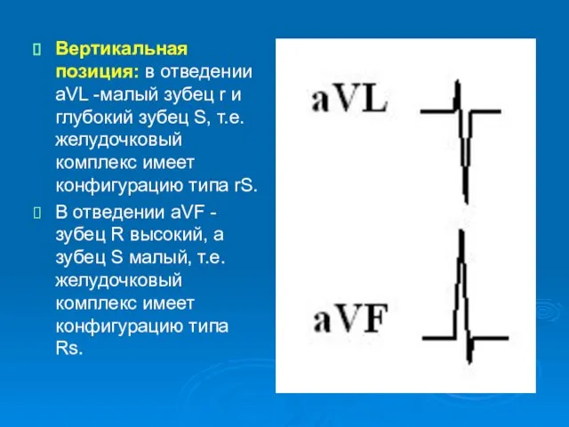 Вертикальная позиция: в отведении аVL -малый зубец r и глубокий