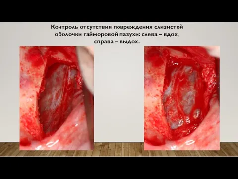 Контроль отсутствия повреждения слизистой оболочки гайморовой пазухи: слева – вдох, справа – выдох.