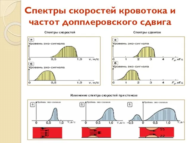 Спектры скоростей кровотока и частот допплеровского сдвига Спектры скоростей Изменение спектра скоростей при стенозе Спектры сдвигов